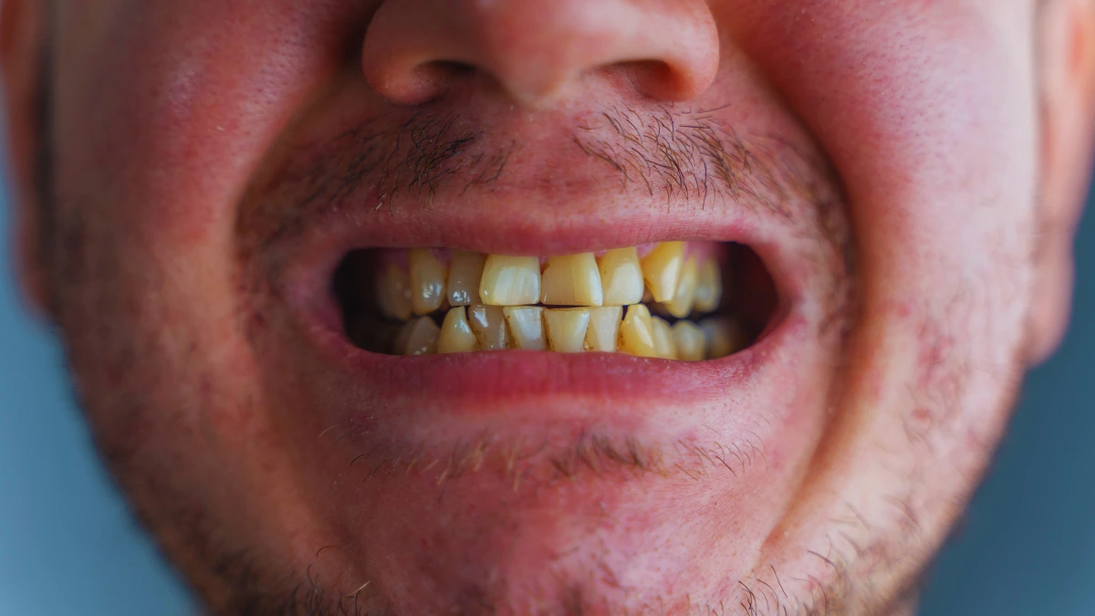 Never Taking Care of Your Teeth