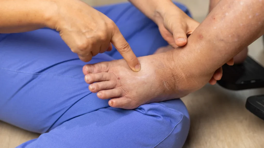 Unexplained Swelling (Edema)
