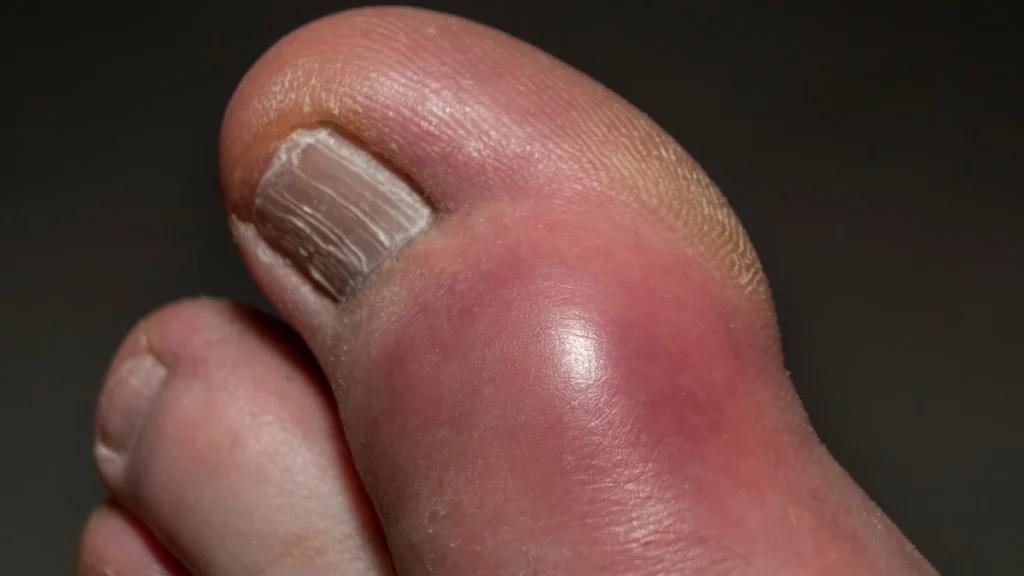 Blue or Purple Toes (Cyanosis)