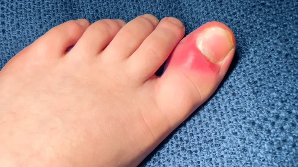 Painful Lumps on Toes (Osler’s Nodes)