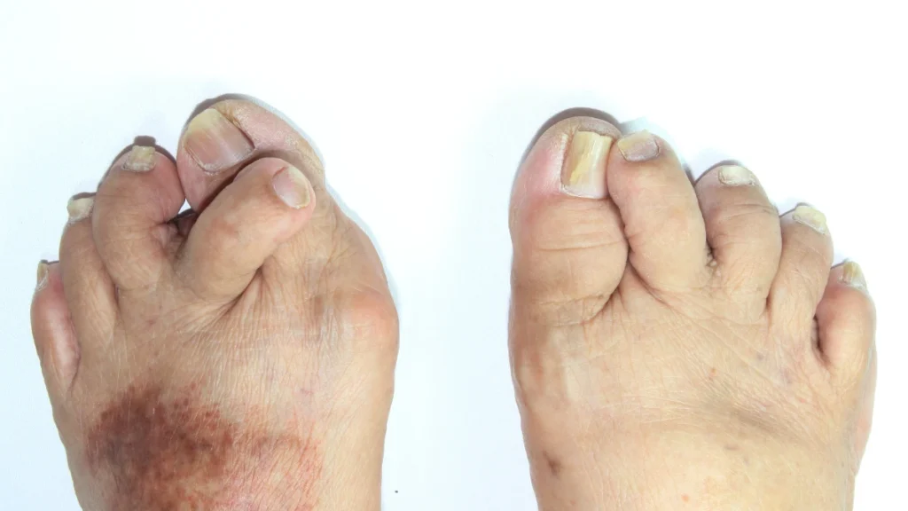 Clubbing of the Toes