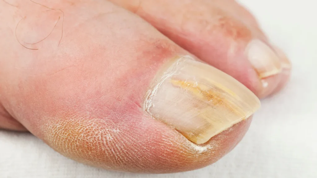 Red Lines Under Toenails (Splinter Hemorrhages)