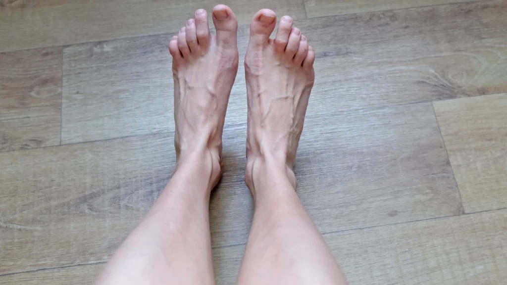 Hair Loss on Feet and Legs