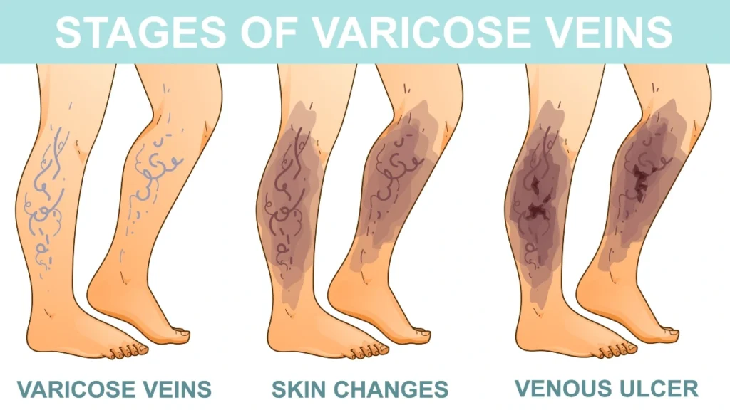 Painful Cramping While Walking (Claudication)