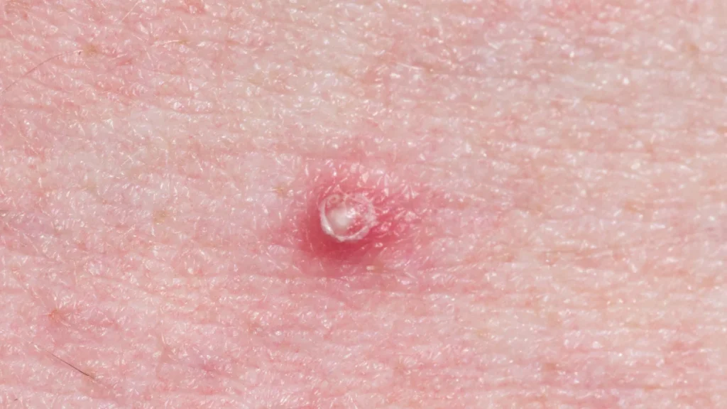 Spider Angiomas