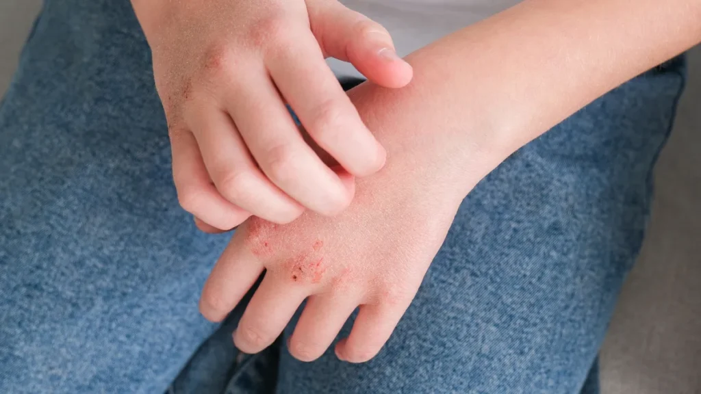 Pruritus (Intense Itching)