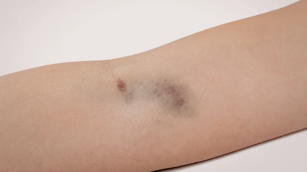 Paper Thin Skin & Bruising