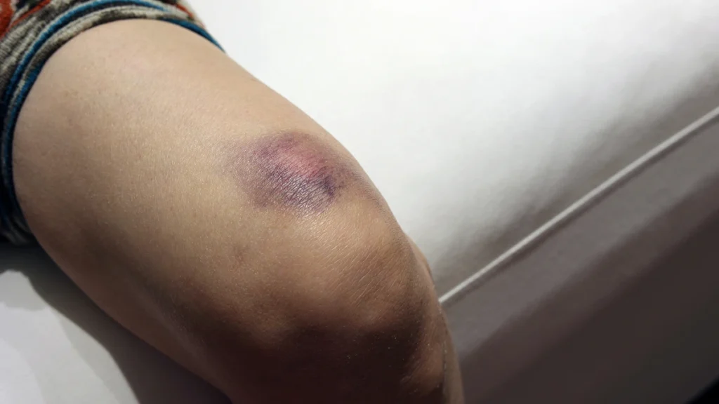 You Bruise Like a Peach