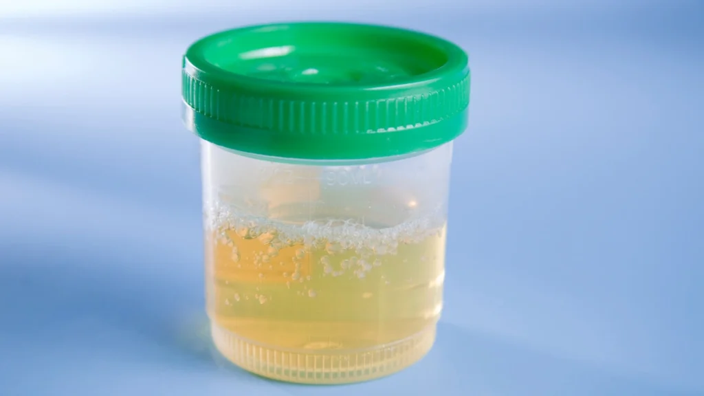 Foamy Urine via The Flush Test