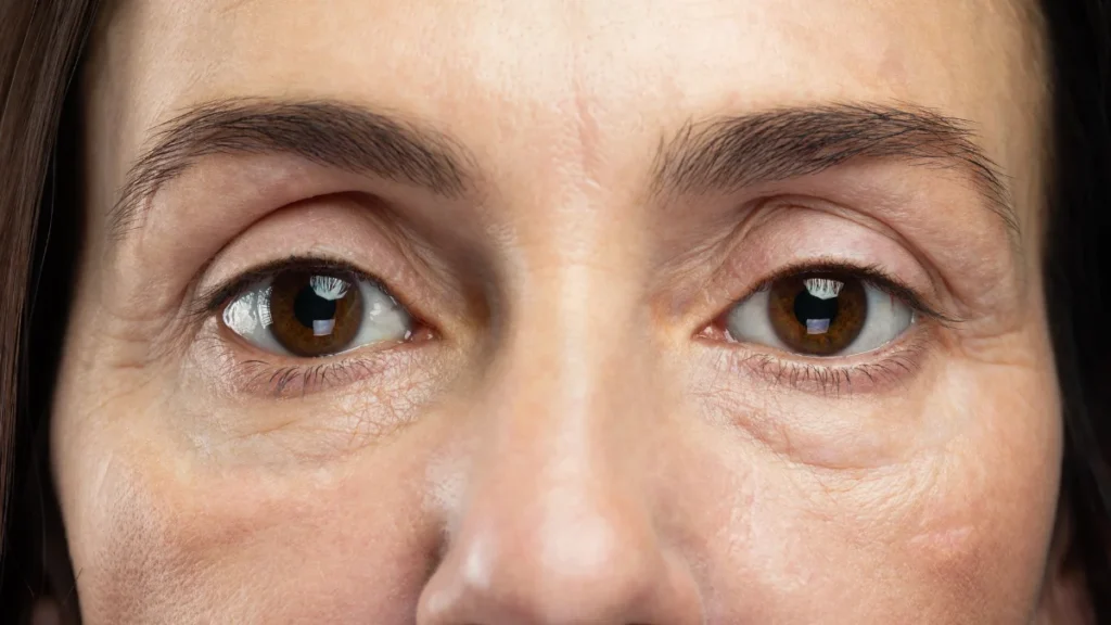 Persistent Puffiness Around the Eyes