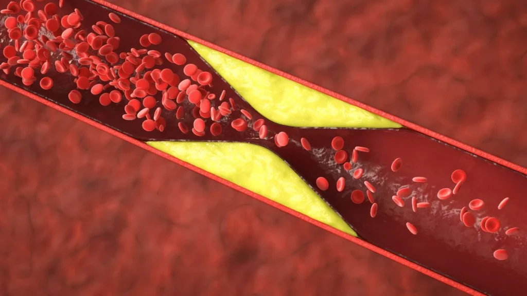 What “Cleaning” Arterial Plaque Really Means