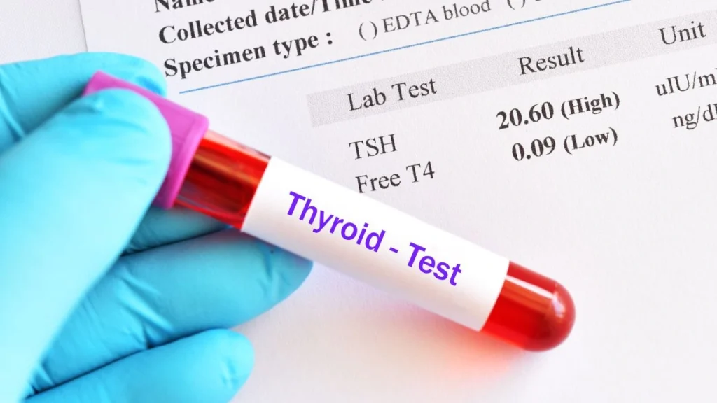Hypothyroidism