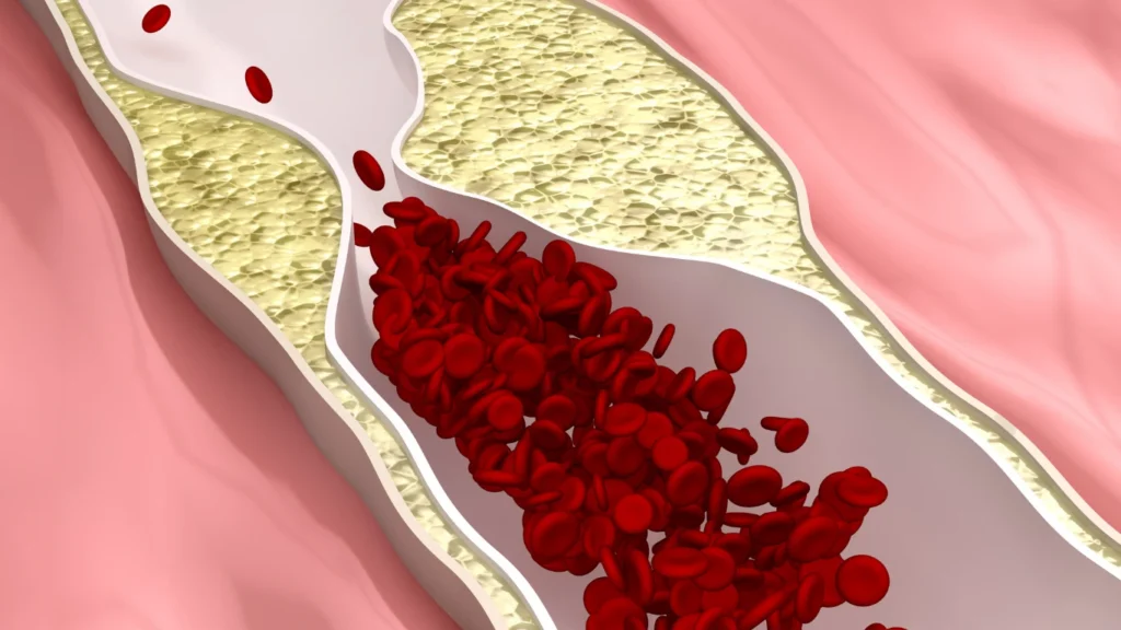 What “Unclog Your Arteries” Really Means